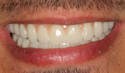 Close up of complete smile after getting implant dentures